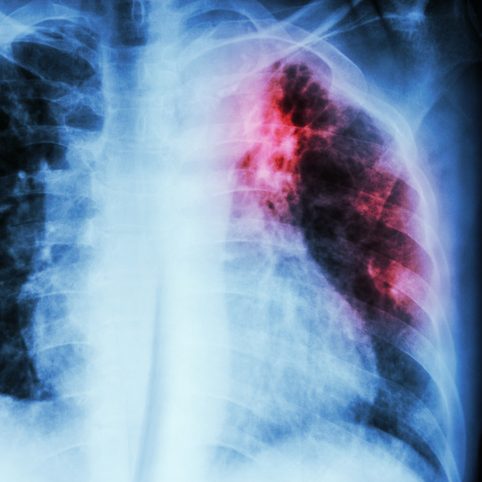 radiografia de pulmones con tuberculosis